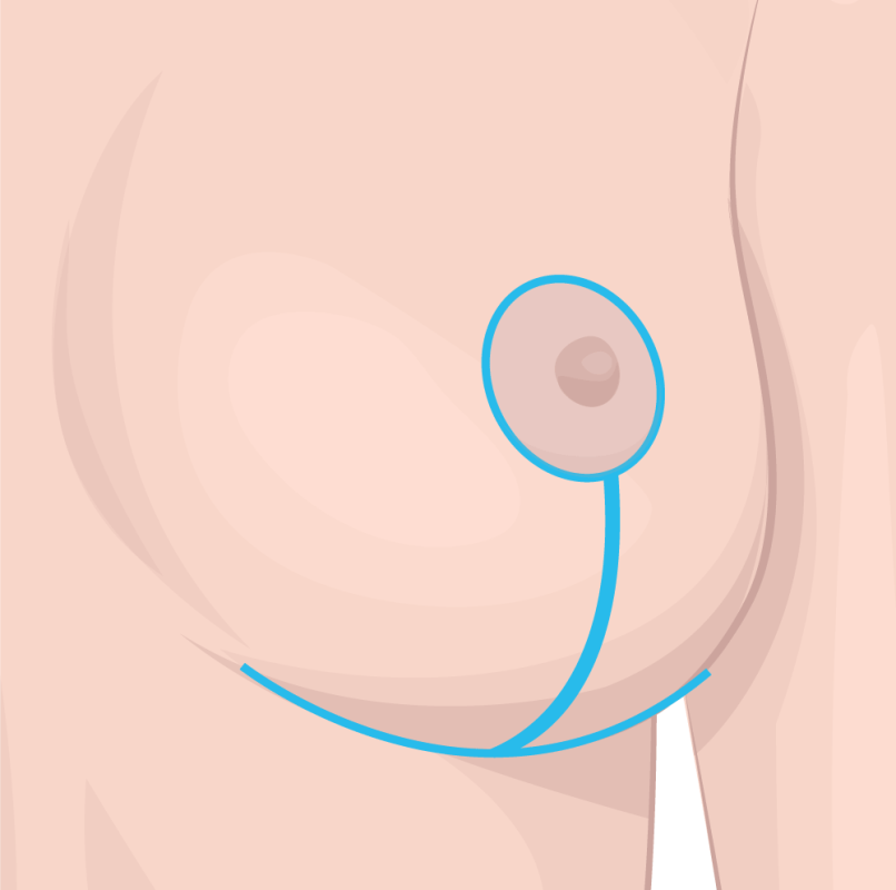 عمل ماموپلاستی