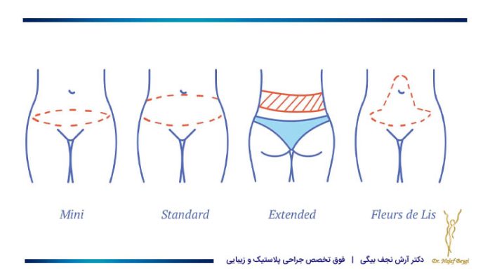 جراحی زیبایی شکم