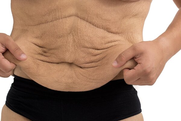 جراحی شکم شل و افتاده