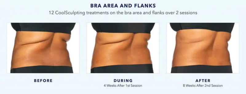 Belly and side slimming package coolsculpting