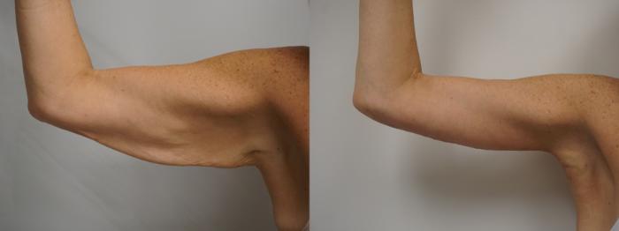 لیفت بازو ( جراحی زیبایی بازو ) براکیوپلاستی