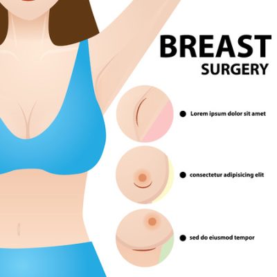 جراحی بزرگ کردن سینه