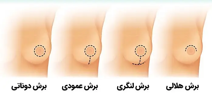 هزینه لیفت سینه