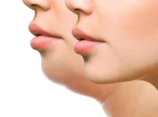 روش های ایجاد زاویه فک - زاویه سازی فک