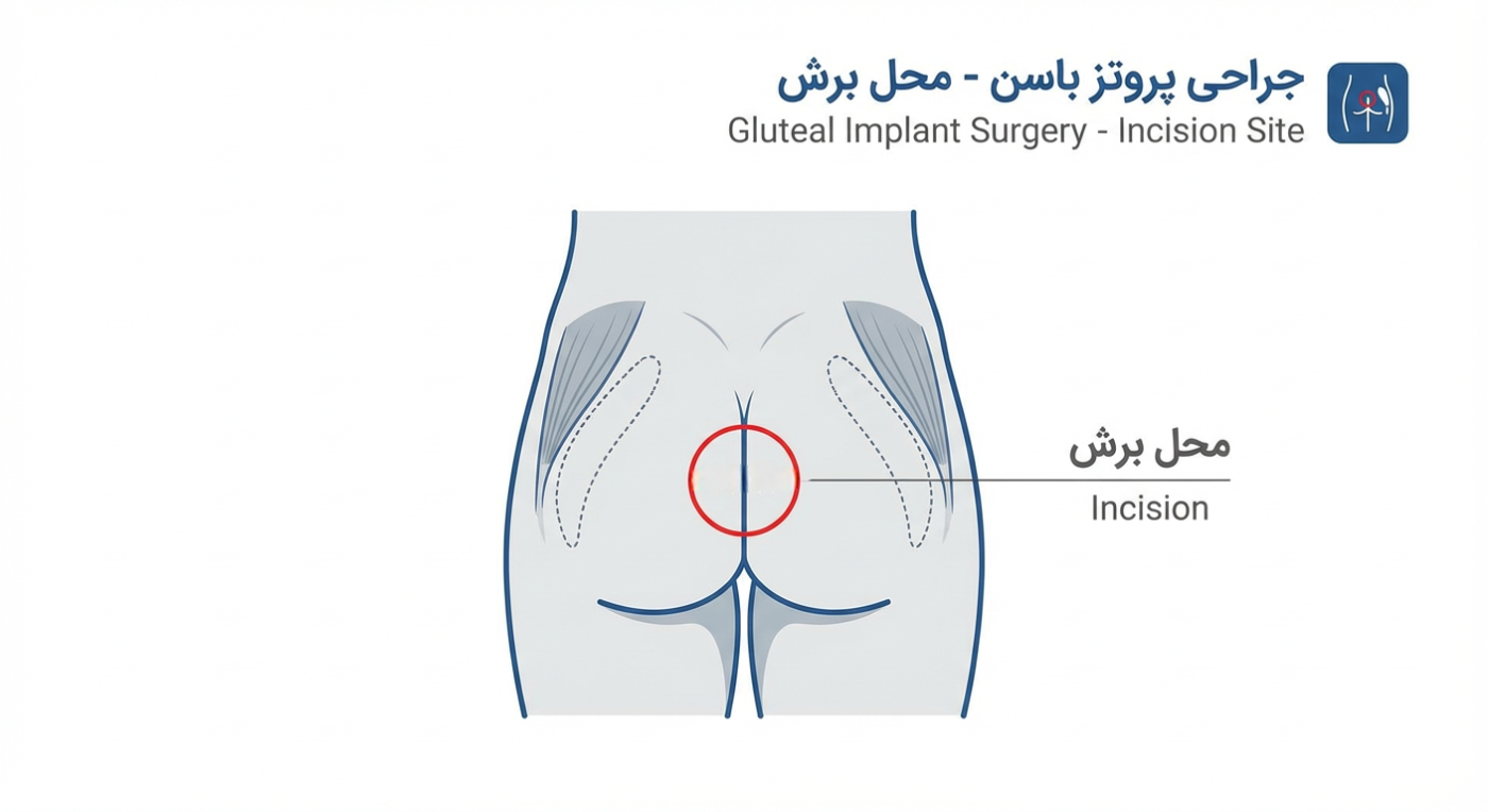 برش جراحی پروتز باسن
