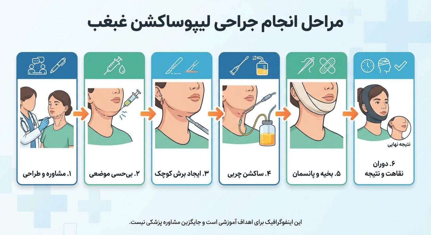 عمل لیپوساکشن غبغب 