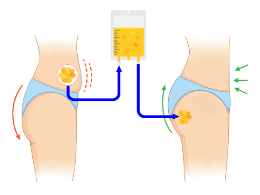 تزریق چربی به باسن