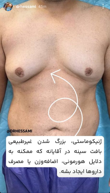 جراحی ژنیکوماستی