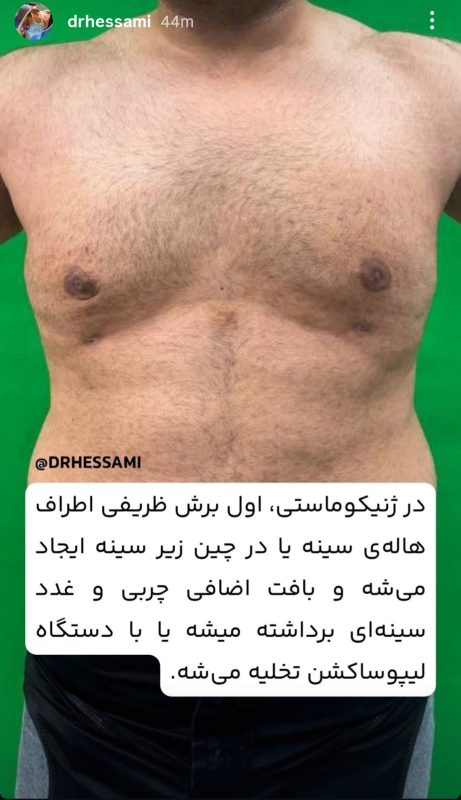 جراحی ژنیکوماستی