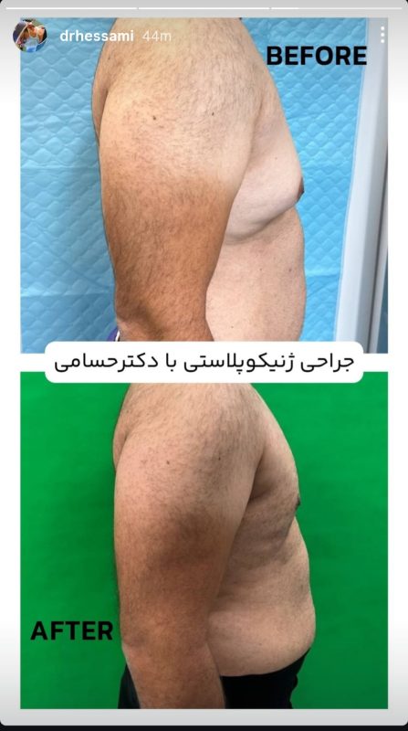 جراحی ژنیکوماستی