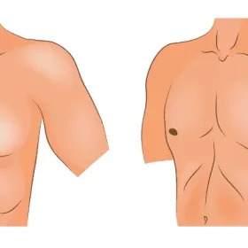 جراحی ژنیکوماستی