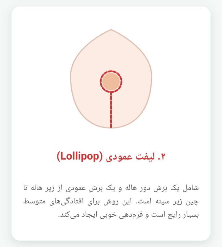عمل لیفت سینه
