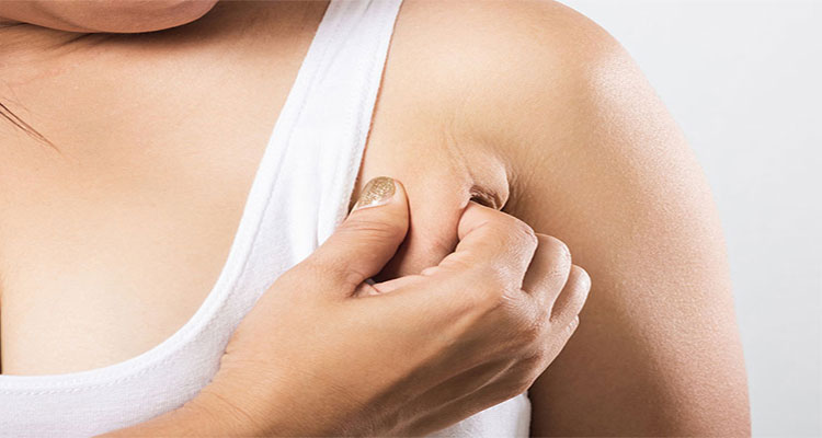 درمان و جراحی سینه سوم یا پستان فرعی