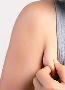 درمان و جراحی سینه سوم یا پستان فرعی