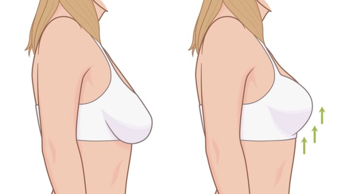 عمل لیفت سینه