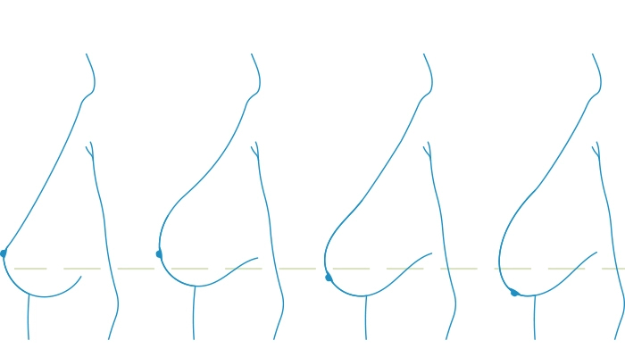 عمل لیفت سینه