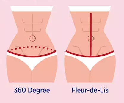 ابدومینوپلاستی بعد کاهش وزن شدید