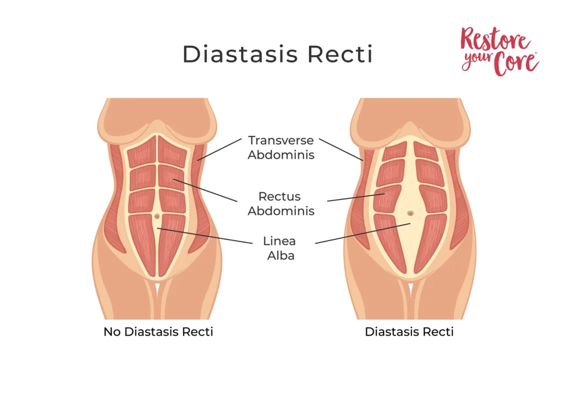 ابدومینوپلاستی چیست