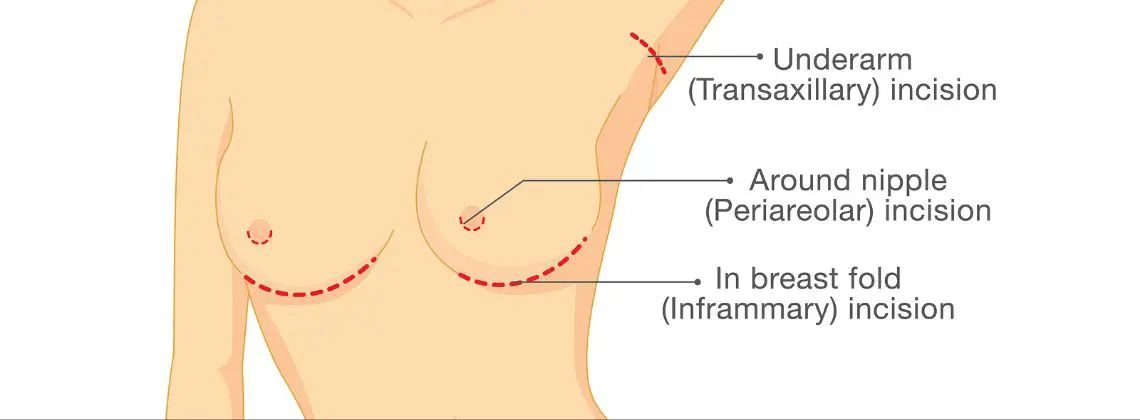 پروتز سینه زیر عضله یا روی عضله