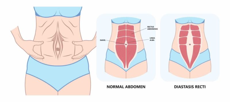 ابدومینوپلاستی درد