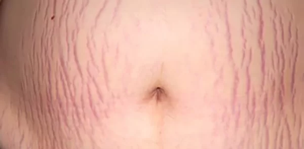 نتیجه عمل ابدومینوپلاستی