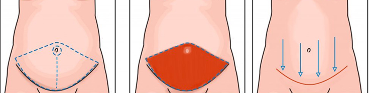 نتیجه عمل ابدومینوپلاستی