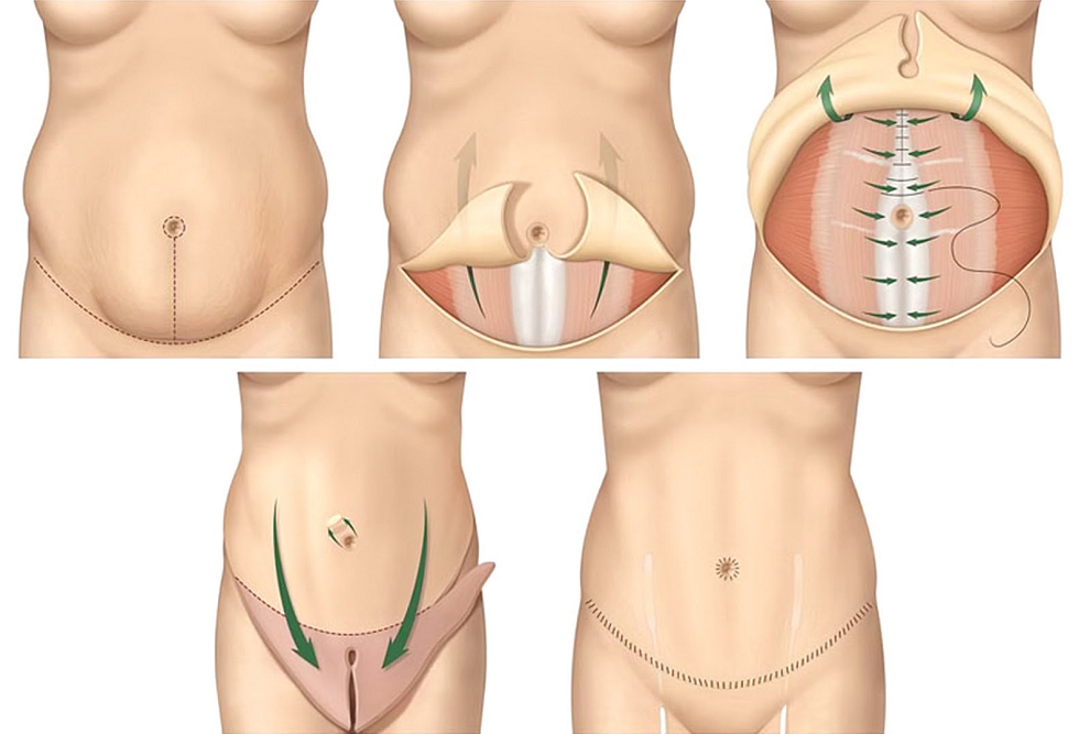 فوق تخصص جراحی پلاستیک شکم