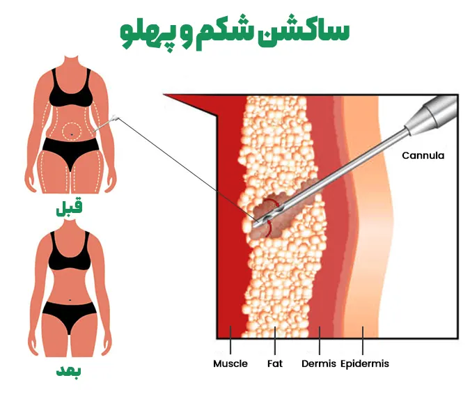 هزینه لیپوماتیک شکم و پهلو