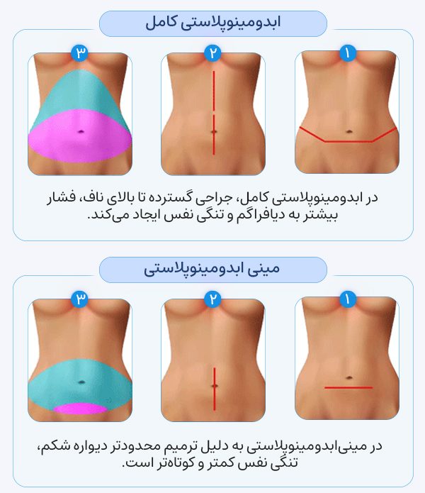 رفع افتادگی شکم با ابدومینوپلاستی